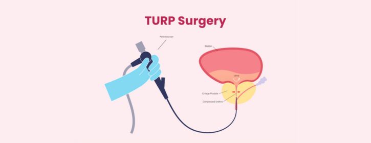 Doctor performing TURP surgery for BPH