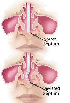 Septoplasty Surgery Fix Deviated Septum & Breathe Better Septoplasty treatment to correct deviated septum