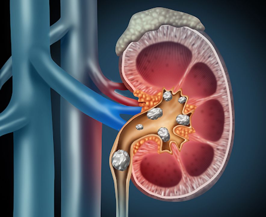 Best minimally invasive kidney stone surgery RIRS
