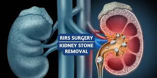 Flexible ureteroscopy RIRS procedure for renal stones